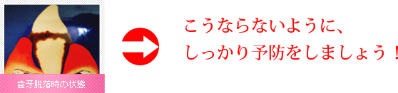 歯周病の進行の流れ