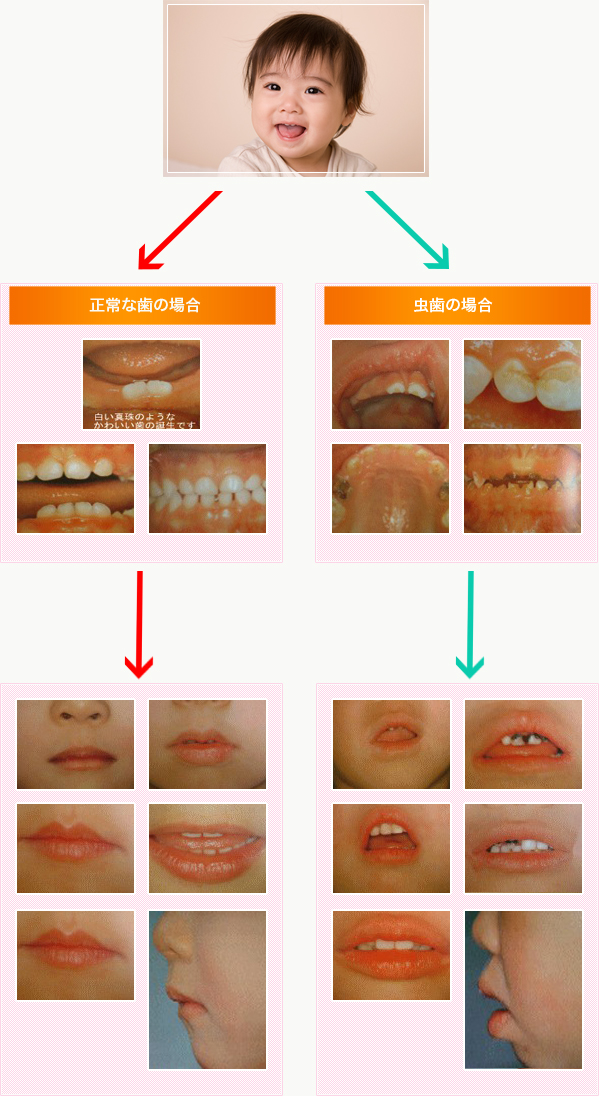 お子様の歯は大丈夫ですか？