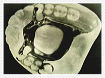 小林歯科医院の義歯