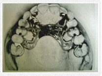 小林歯科医院の義歯